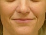 Treatment of prominent nasolabial folds with dermal filler