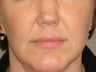Treatment of prominent nasolabial folds with a dermal filler