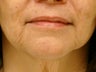 Treatment of marionette lines with a dermal filler