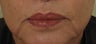 Juvederm