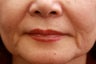 Injectable Filler