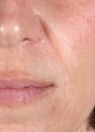 Juvederm 