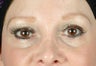 Juvederm