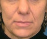 Juvederm