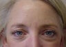 Juvederm