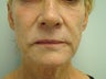 Juvederm