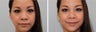 Nasal filler