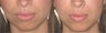 Smile lines treated with Juvederm