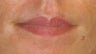 Juvederm