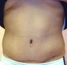 Tummy Tuck