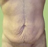 Tummy Tuck