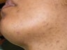 Laser hair removal in African-American