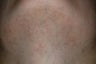 laser hair reduction