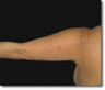 Laser Lipo