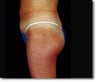 Laser Liposuction