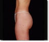 Laser Liposuction