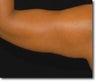 Laser Liposuction