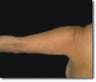 Laser Lipo
