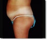 Laser Liposuction