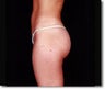 Laser Liposuction
