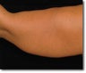 Laser Liposuction