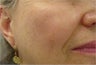 Sunspot freckle  treatment