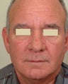 Rhinophyma-CO2 resurfacing