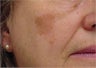 Sunspot freckle  treatment