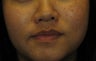 Laser Peels and More Perfect for Ethnic Skin Tones