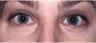 Laser Resurfacing with Erbium laser