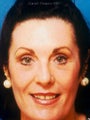 Full face laser resurfacing with endoscopic browlift and lower blepharoplasty