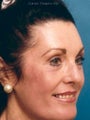 Full face laser resurfacing with endoscopic browlift and lower blepharoplasty