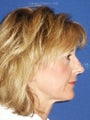  Full face erbium laser resurfacing 