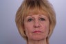 Laser Resurfacing