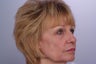Laser Resurfacing