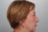 Laser resurfacing for dyschromia (brown spots)