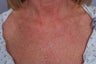 Laser treatment to Chest