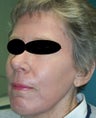Full face laser resurfacing