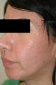 Erbium Laser Resurfacing for Acne Scars