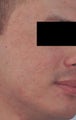 Laser Resurfacing for Acne Scars