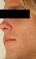 Laser Resurfacing for Enlarged Pores