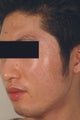 Laser Resurfacing 
