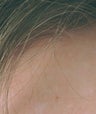 Laser treatments for Sebaceous Hyperplasia 