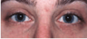 Laser Resurfacing with Erbium laser