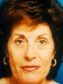 Full face laser resurfacing with endoscopic browlift and lower blepharoplasty