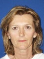 Full face erbium laser resurfacing