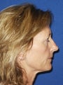  Full face erbium laser resurfacing 