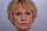 Laser Resurfacing