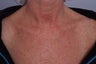 Laser treatment to Chest