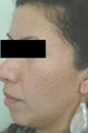 Erbium Laser Resurfacing for Acne Scars